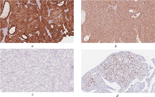 Immunohistochemical staining of the tumour (original magnification ×100). CK7 (a) and S-100 (b) are positive, whereas CDX-2 (c) is negative. (d) Ki-67 proliferation index focally reaches up to 20%.
