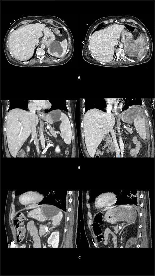 Preoperative evolution of splenic abscess into GSF at imaging. (A) Axial scans. (B) Coronal scans. (C) Sagittal scans.