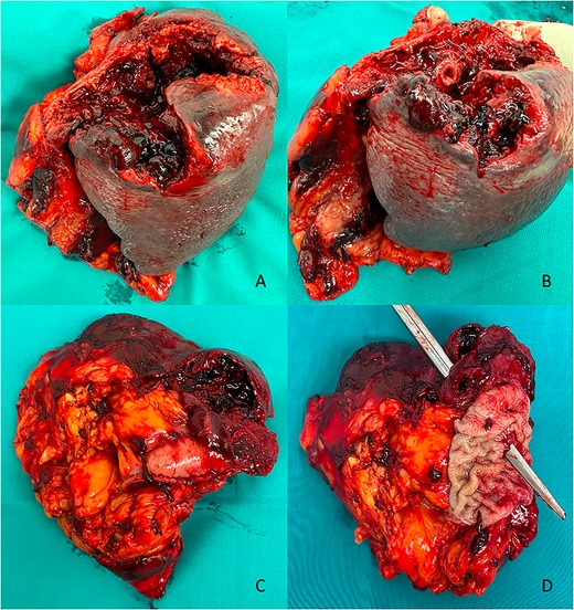 Postoperative macroscopic view. (A) Anterior view of the splenic blood–abscess collection. (B) Anterior view of the GSF. (C) Posterior view of the splenic blood–abscess collection with the gastric stump. (D) Posterior view of the GSF.