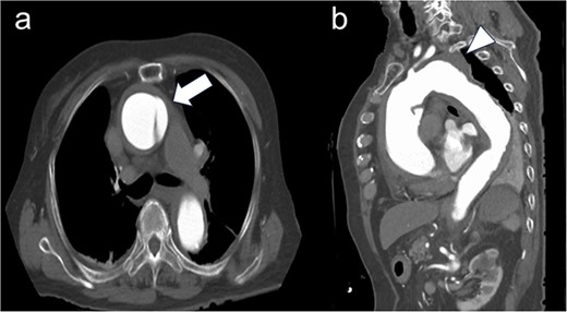 Preoperative computed tomography imaging. (a) There was a flap at the ascending aorta, a finding of acute aortic dissection of Stanford type A (white arrow). (b) A 54 mm large thoracic aortic aneurysm was found at the distal arch aorta (white arrow head).