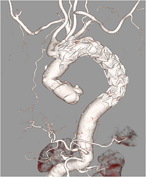 Postoperative enhanced-computed tomography findings. There were no problematic findings, although a slight type 4 endoleak was present.