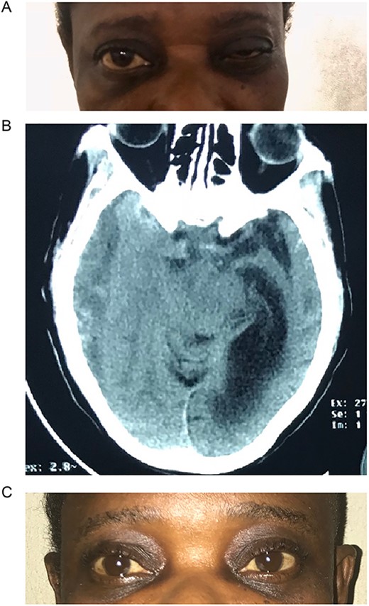 (A) Pre-op with right ptosis/ophthalmoplegia. (B) Pre-op axial CT showing right CSDH. (C) Post op with resolution of ptosis.