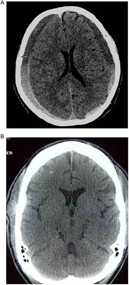 (A) Pre-op showing bilateral CSDH. (B) Post op complete resolution of CSDH.