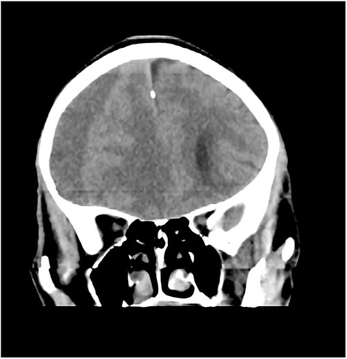 Coronal CT with right CSDH.