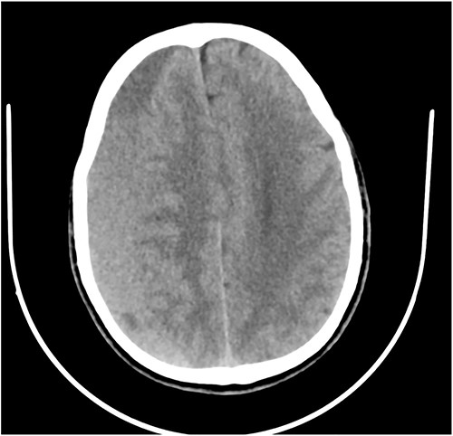 Axial CT showing CSDH.