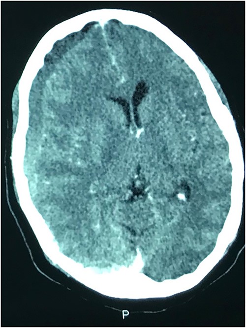 Axial contrast CT showing right CSDH.