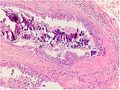 Microscopic examination shows high grade ductal carcinoma cells confined within the base membrane with necrosis. H&E 20×.