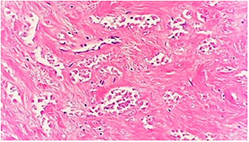 Microscopic examination shows a sheet of nonviable tumor cells with necrosis. H&E 20×.