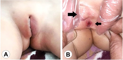The genital area of Case 1 on presentation. (A) The external genital organs correspond to a feminine appearance with developed labia majora. (B) Retraction of the labia exposes the clitoromegaly (large arrow) and the perineal urethral meatus (small arrow). The examination shows a primitive vestibule with a blind vaginal stump.