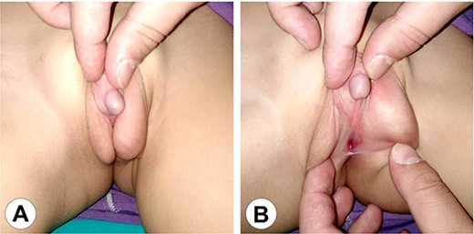 The genital area of Case 1 after 6 months of hormonal therapy. (A) The scrotum shows marked development and the penis can be seen protruding between the scrotal clefts. (B) A perineal hypospadias can now be identified at the root of the scrotum.