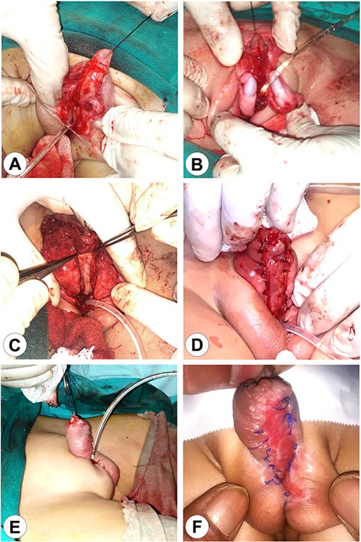 The first stage of the surgical reconstruction. (A) Preparation of the skin flaps with penis release and scrotal reconstruction. (B) Bilateral orchidopexy. (C) Transplantation of an autograft from the patient’s lip on the ventral surface of the penis. (D) Fixation of the implant. (E) The completed reconstruction with a Foley catheter in the perineal urethra. (F) The completed first stage after wound healing.