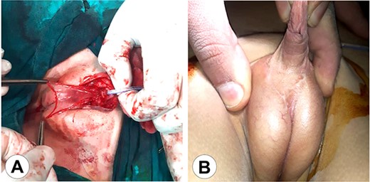 The second stage of the surgical therapy. (A) The urethra was lifted from the scrotum to the glans reinforcing the urethral reconstruction using an amniotic membrane. (B) The final result after wound healing.