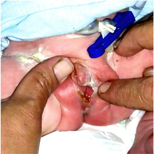 The genital area of a newborn brother of the patients in this series (Case 3) shows the same anomaly with a female pattern and clitoromegaly.