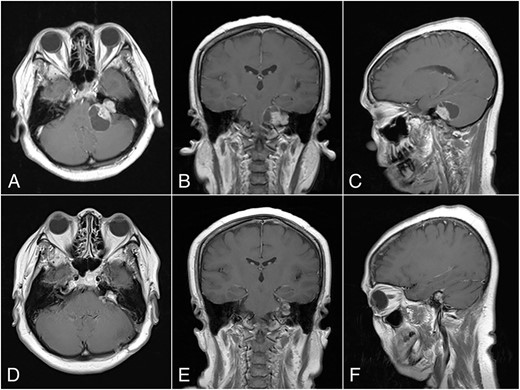 Preoperative MRI, (A) Axial, (B) Coronal, and (C) Sagittal plane, shows a “dumbbell” shaped vestibular schwannoma. Postoperative MRI, (D) Axial, (E) Coronal, and (F) Sagittal plane, shows near total resection with some residual mass on the left CPA.