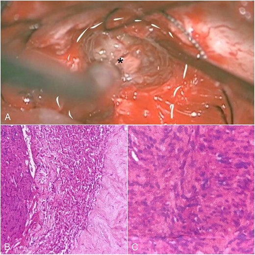 Intraoperative view and histopathological feature. (A) After debulking of the tumor, IAC was opened, and the intrameatal globular part (asterisk) could be appreciated and resected. (B) Histopathological findings show tumor cells with blood vessel proliferation that consist of collagen. (C) Schwann cells mixed with neuroma cells making a palisade-shaped structure.