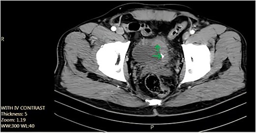 Axial pelvic CT scan shows large urinary bladder tumor (arrow).