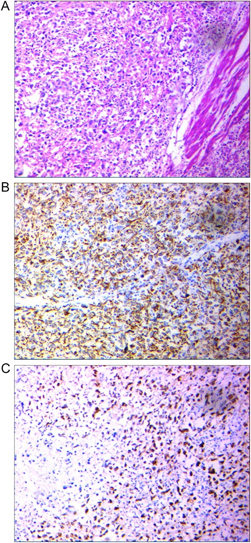 (A) Tumor with epithelial source, the proliferation of giant cell with polymorph nuclei and eosinophilic, Hematoxylin and eosin-stained section ×100. (B) Positive AE1/AE3 marker to point its epithelial source, IHC × 100. (C) Positive P53 point to High-grade tumor, IHC × 100.