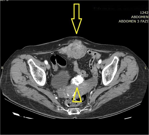 Abdominal computerized tomography (axial scan) shows a tumor in the abdominal wall (arrow) with the secondary finding of calcified uterine myoma (arrowhead).