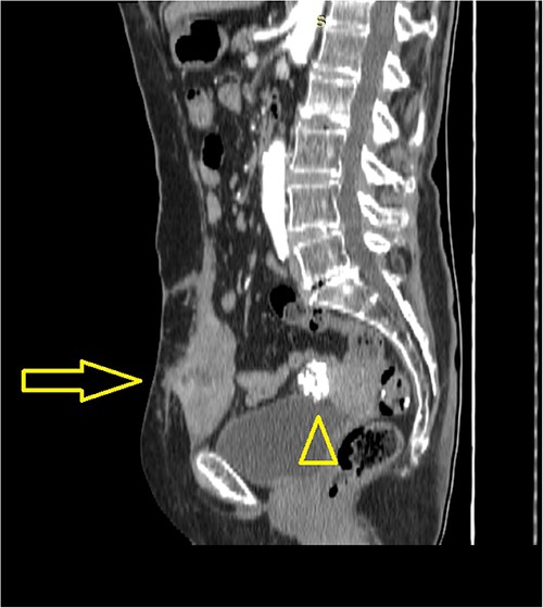 Abdominal computerized tomography (sagittal scan) shows a tumor in the abdominal wall (arrow) with the secondary finding of calcified uterine myoma (arrowhead).