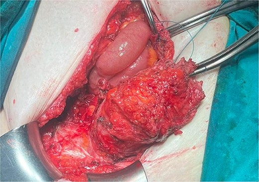 Intraoperative finding of the anterior wall metastasis during removal.