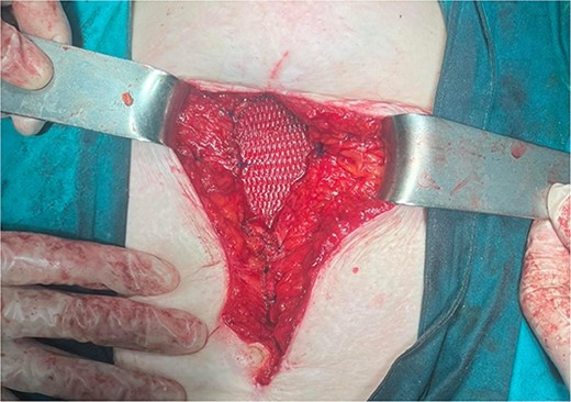 Abdominal wall defect reconstruction by the use of composite mesh.