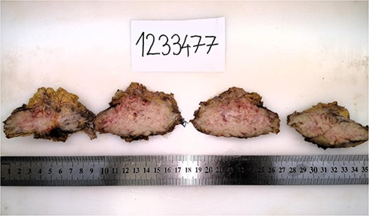 Macroscopic view of serial metastasis dissection.