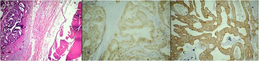 Microscopic pathology analysis of the metastasis. (A) Hematoxylin Eosin stain showing metastatic infiltrate of adenocarcinoma into soft tissue (abdominal wall muscle). (B) Immunohistochemistry stain showing positivity on CDX2. (C) Immunohistochemistry stain showing positivity on CK20.