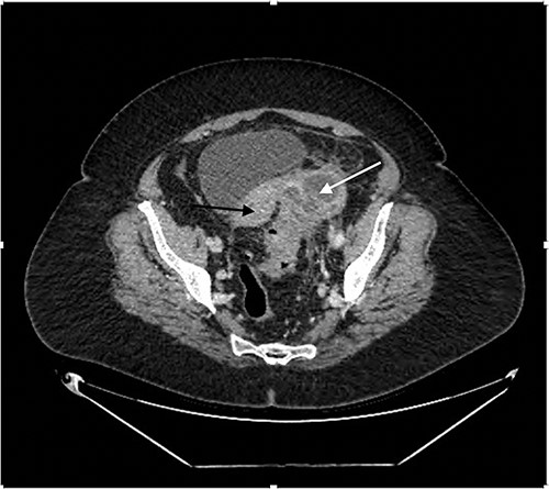 Contrast enhanced CT Abdomen/Pelvis demonstrating mixed cystic/solid LIF mass (white arrow) adherent to the sigmoid colon and uterus (black arrow).