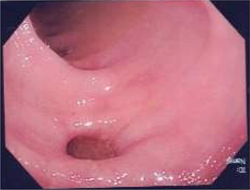 Colonoscopy following first hospital admission, demonstrating evidence of sigmoid diverticular disease, with no evidence of fistula formation.