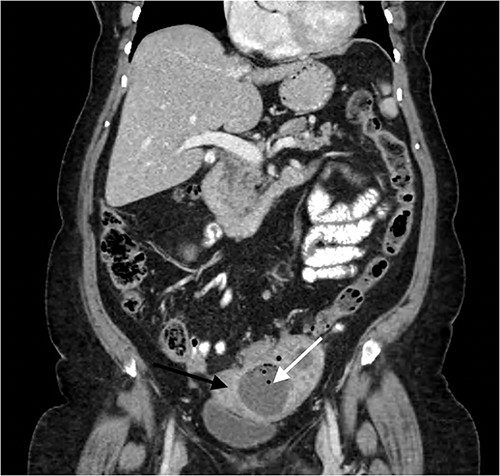 Contrast enhanced coronal CT Abdomen/Pelvis revealing a larger multi-loculated rim enhancing LIF mass (white arrow) adherent to the uterus (black arrow), with air fluid levels and multiple locules of gas.