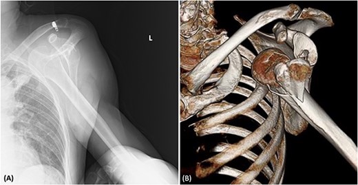 (A) Radiography showing the dislocation of the left shoulder joint. (B) 3D-CT showing a humeral fracture.