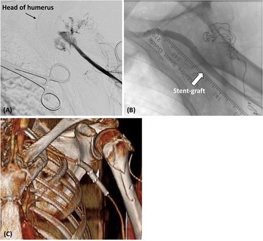 (A) The catheter was inserted from the left brachial artery, and angiography revealed the extravasation of the axillary artery. (B) Stent grafts were placed at the site of the axillary artery rupture to confirm that there was no leakage. (C) Postoperative contrast-enhanced CT revealed that blood flow in the axillary artery was maintained.