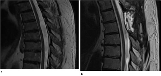(a) Dorsal indentation (scalpel sign) demonstrated in thoracic spine preoperatively (Patient A). (b) Postlaminectomy and resection of posterior arachnoid web demonstrating resolution of dorsal indentation and cord signal changes (Patient A).