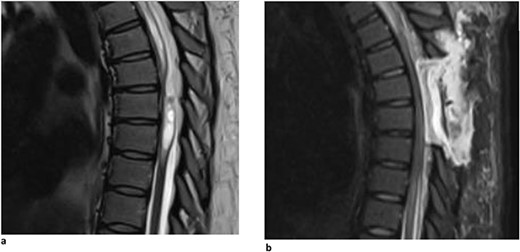 (a) Dorsal indentation demonstrated in thoracic spine preoperatively (Patient B). (b) Postlaminectomy and resection of posterior arachnoid web demonstrating resolution of dorsal indentation and cord signal changes (Patient B).