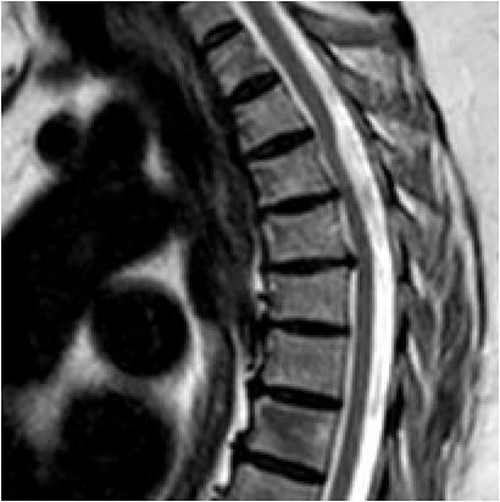 Dorsal indentation demonstrated in thoracic spine preoperatively (Patient C).