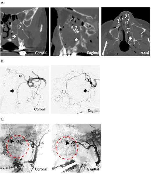(A) Postoperative coronal, sagittal, and axial computed tomography images, which show the separated bone parts of the left maxilla (arrow). (B) Coronal and sagittal selective angiographic images from the left internal maxillary artery. The arrow indicated a pseudoaneurysm of the left descending palatine artery. The asterisk indicated the left sphenopalatine artery. (C) After embolization and coronal and sagittal selective angiographic images. The Triangular arrow indicated the endovascular coils, and the circle indicated the disappearance of the vascular flow area.