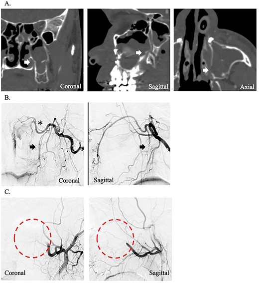 (A) Postoperative coronal, sagittal, and axial computed tomography images, which show the separated bone parts of the left maxilla (arrow). (B) Coronal and sagittal selective angiographic images from the left internal maxillary artery. The arrows indicate the suspected region of injury to the left descending palatine artery. The asterisk indicated the left sphenopalatine artery. (C) After embolization and coronal and sagittal selective angiographic images. The circle indicated the disappearance of the vascular flow area.