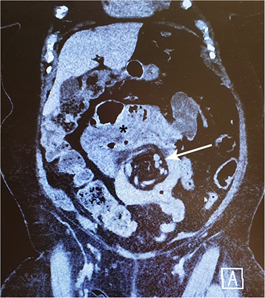 A 77-year-old woman with a history of jejunoileal bypass 31 years ago presented with intermittent colicky upper abdominal pain for 1–2 years. A rather painful episode led to hospital admission and CT scan, which showed a mesenteric swirl sign (arrow). Symptoms quickly subsided. Although she remained symptomless after that particular episode, an exploratory laparoscopy converted to laparotomy was performed 5 months later. This revealed a large mesenterial defect under the jejunoileal anastomosis. 390 cm of bypassed small bowel was found to be atrophied and packed with adhesions. This finding may be visible on CT scan (*).