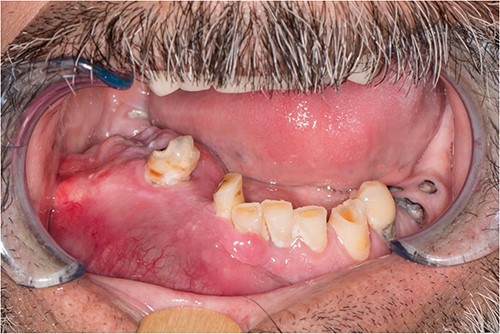 Physical examination revealing an evident large right mandibular lesion present in the patient.