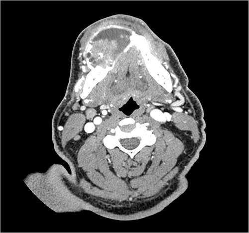 CT imaging demonstrating the heterogeneous, multiloculated, expansile lesion stretching in the buccal-lingual direction.