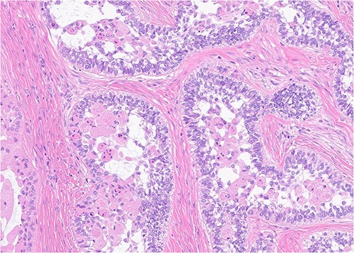 Histopathology (400×, H&E strain) demonstrating characteristic granular cell ameloblastoma features such as epithelial tumor islands with columnar cells exhibiting peripheral palisading, stellate reticulum-like areas, granular cells, and reverse polarization.