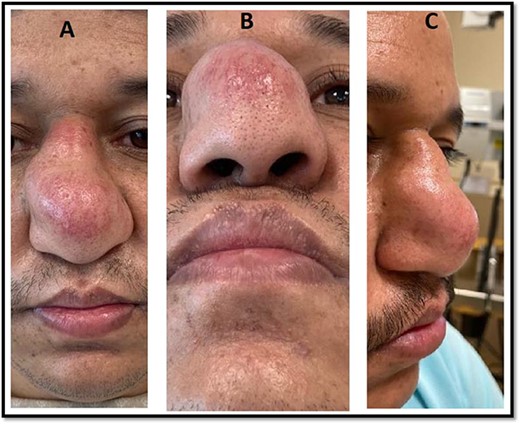 Preoperative picture of the patient’s nasal dorsal swelling.