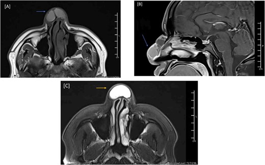 MRI of the head, and paranasal sinuses (Pre-Op). (A) There is a lobulated multilocular cystic lesion seen at the dorsum of the nose, some of the cysts are showing bright signal intensity in T1 (arrow) and T2/FLAIR (C) (arrow) representing high proteinaceous content. No connection to the cranial cavity, features are likely presenting dermoid cyst. (B) The lesion shows peripheral postcontrast enhancement. No diffusion restriction.