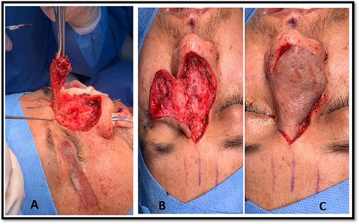 Intraoperative picture of the patient’s nasal dorsal swelling. Panel (A) shows the swelling before excision. Panel (B) shows the dorsum of the nose after swelling excision. Panel (C) shows the raised dorsal nasal flap.