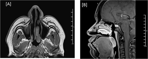 MRI of the head, and paranasal sinuses (post-op). (A, B) Axial and Mid-sagittal T1 sequence showing total resection of the external nasal mass lesion with a heterogenous enhancement seen likely postoperative changes. No obvious residual mass lesions can be seen.