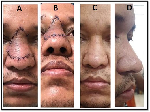 Postoperative pictures showing the short-term outcome of the procedure (A, B) and the long-term outcome (C, D).