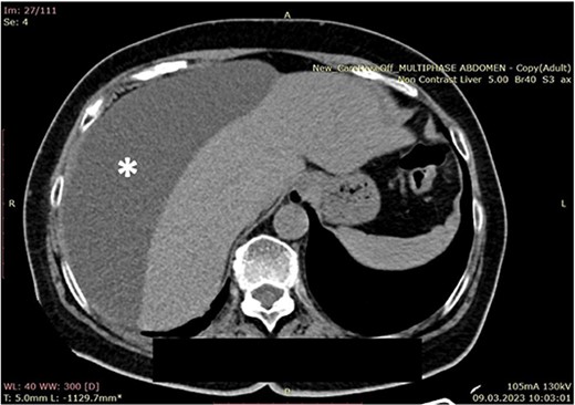 Computerized abdominal tomography (axial scan) showing a large biloma in the right subphrenic region (asterisk).
