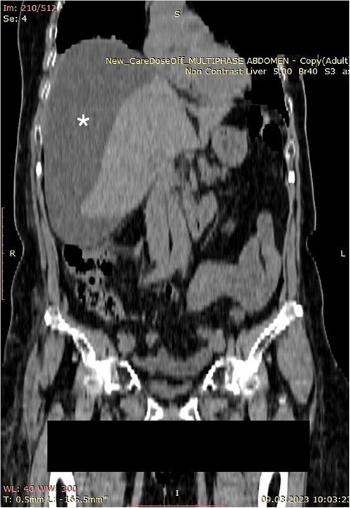 Computerized abdominal tomography (coronal scan) showing a large biloma (asterisk).