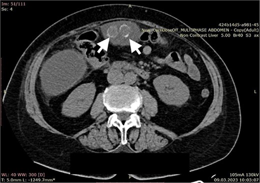Computerized abdominal tomography (axial scan) showing two free gallstones in the intraabdominal cavity (arrows).