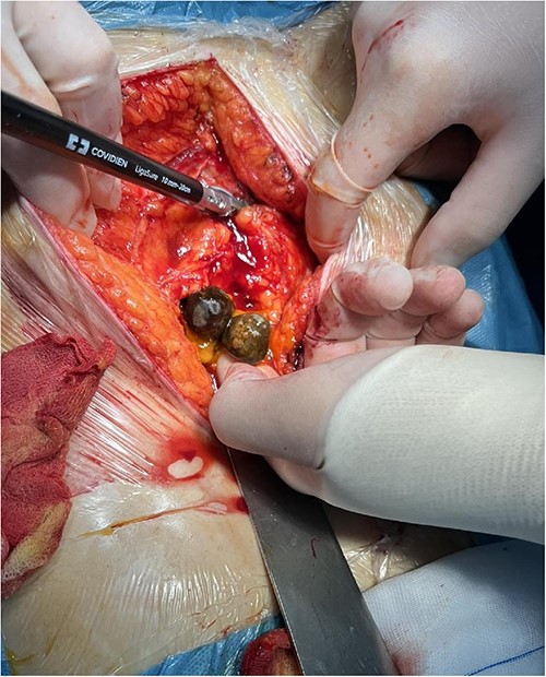 Intraoperative finding (free gallstones in the abdominal cavity).